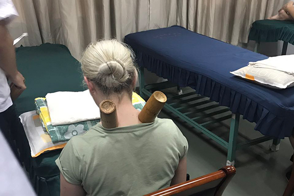 Students experiencing cupping therapy